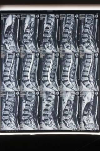 MRI画像 坐骨神経痛